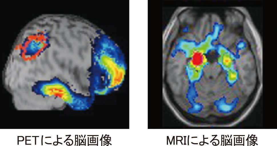 PET検査とMRI検査を組み合わせた脳PET検査