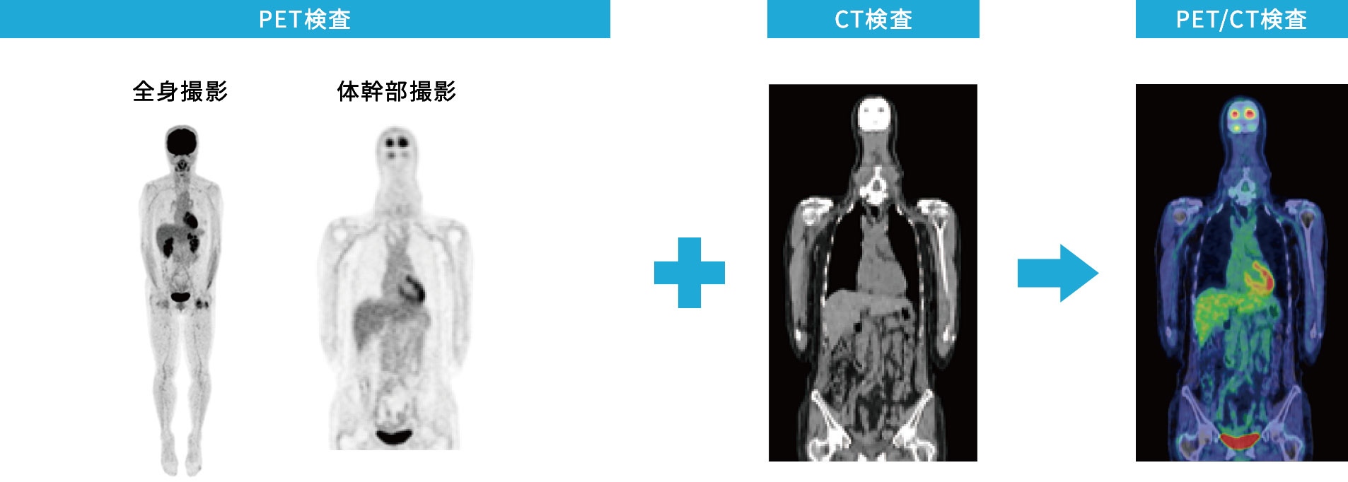 PETとCTの融合による、より「見える」診断に