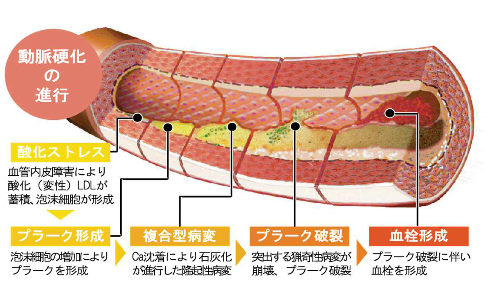 動脈硬化の進行